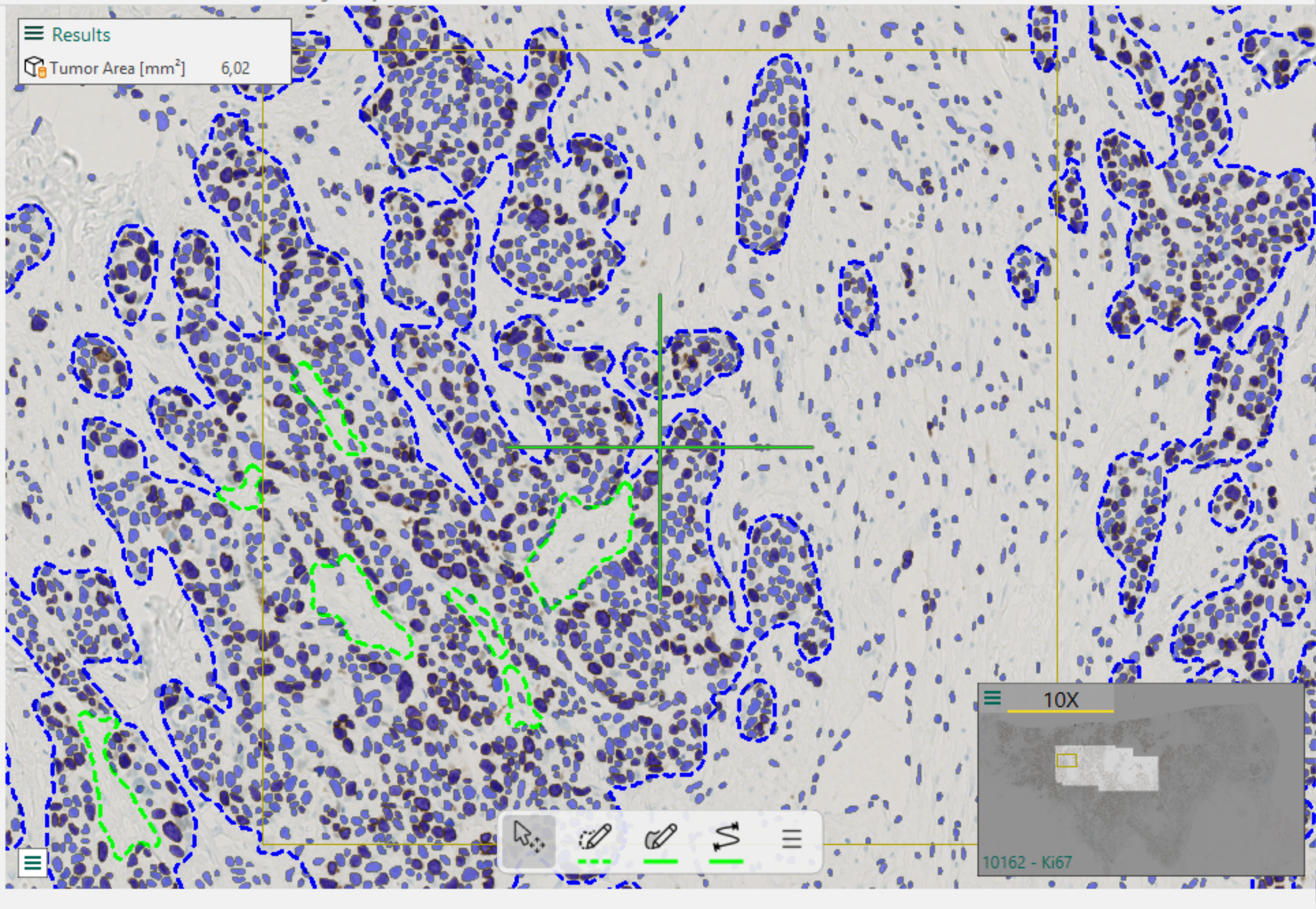 Final result after running the Tumor Detection APP with the revert configuration. The cell labels generated by the Nuclei Detection APP are preserved, while tumor ROIs are successfully created.