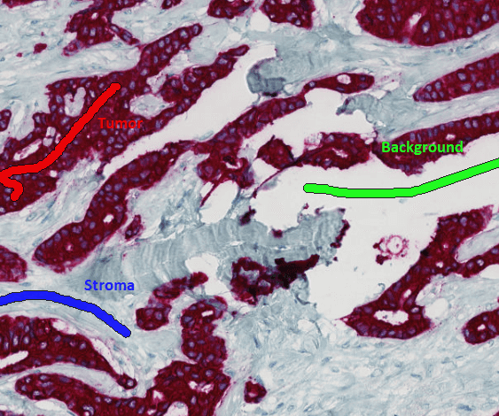 P63CK stained tumor, with 3 training labels drawn