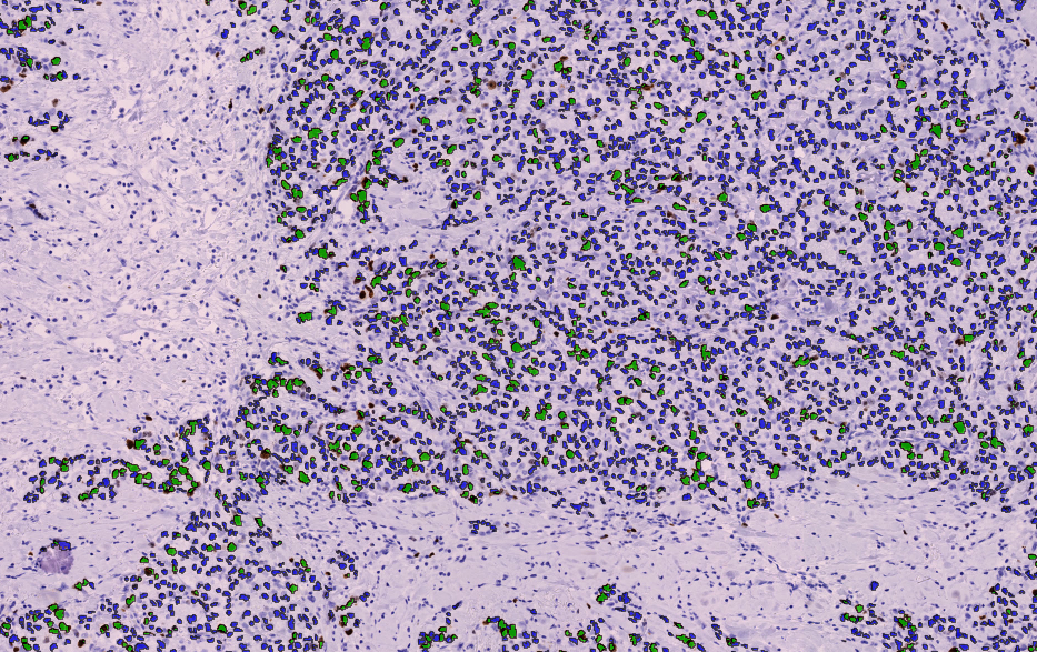 Green labels: Positive nuclei. Blue labels: Negative nuclei (Lymph Node).