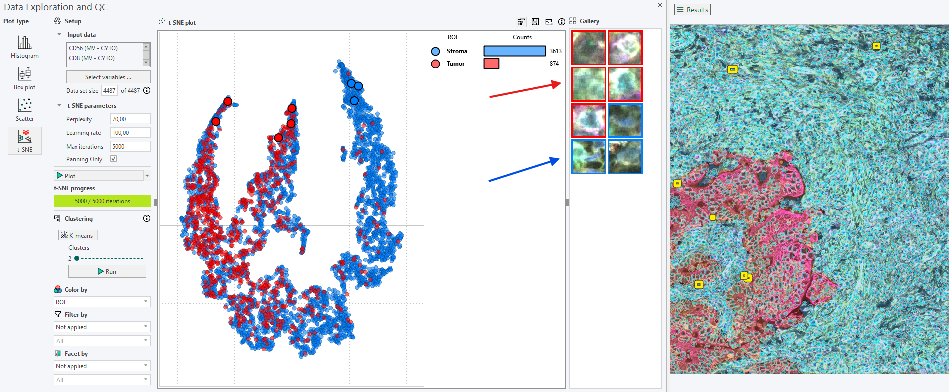 Selecting 8 points of interest in the t-SNE plot, which are then highlighted in yellow in the image and visible in the Gallery, Tumor (red) and Stroma (blue).