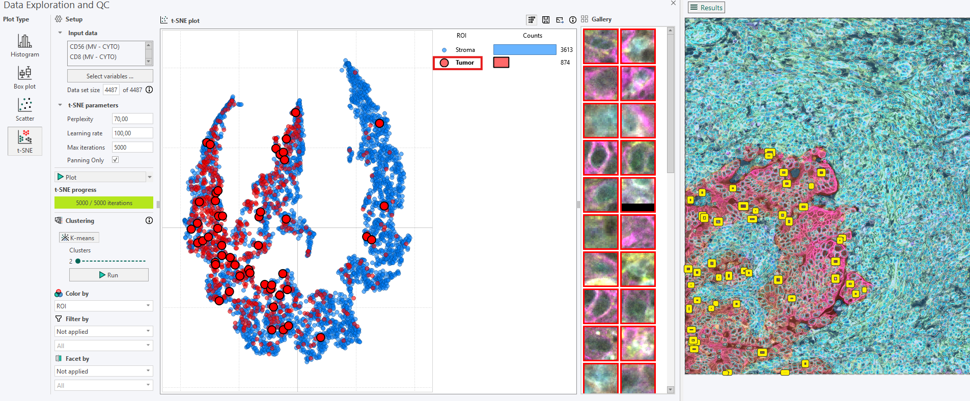 Extracting a random sample of Tumor cells. The selected cells are shown as yellow squares in the image and highlighted in the t-SNE plot.
