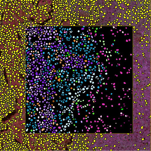 Classification result of trained Phenomap APP shown in the field-of-view (Lung cancer tissue).