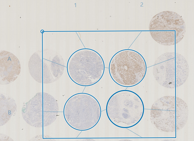 Grid adjusted to fit cores of interest (Breast tissue Ki67 staining).