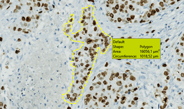 Example of a custom drawn ROI. The ROI is marked as yellow to indicate that it is now highlighted (Lung tissue stained with DAB and hematoxylin).