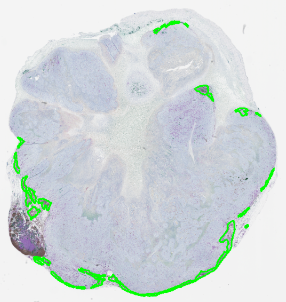 An image of a tumor with imported overlay. Opening the XML Document '026b' with Layer Data imports an overlay to the image that is currently open.
