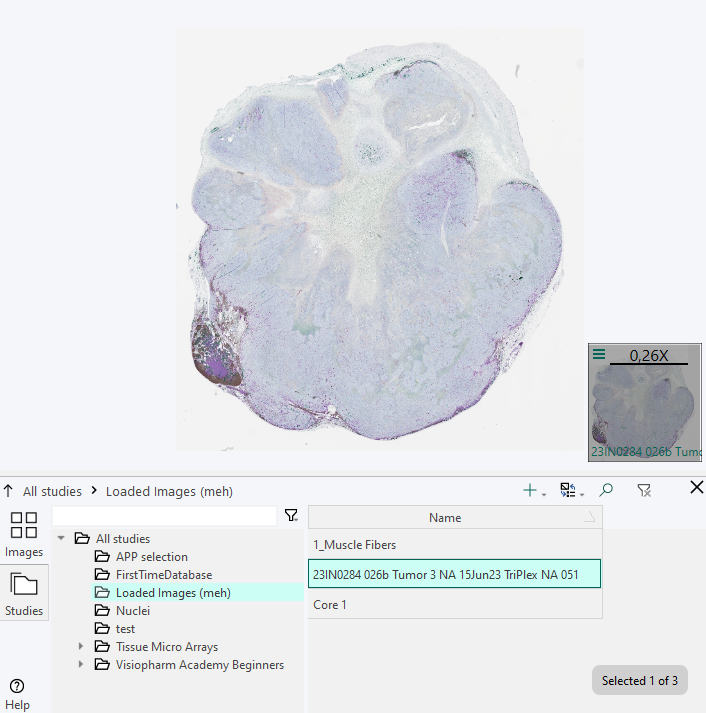 The image of Tumor 3 is selected and loaded into studies in the folder 'Loaded Images'.