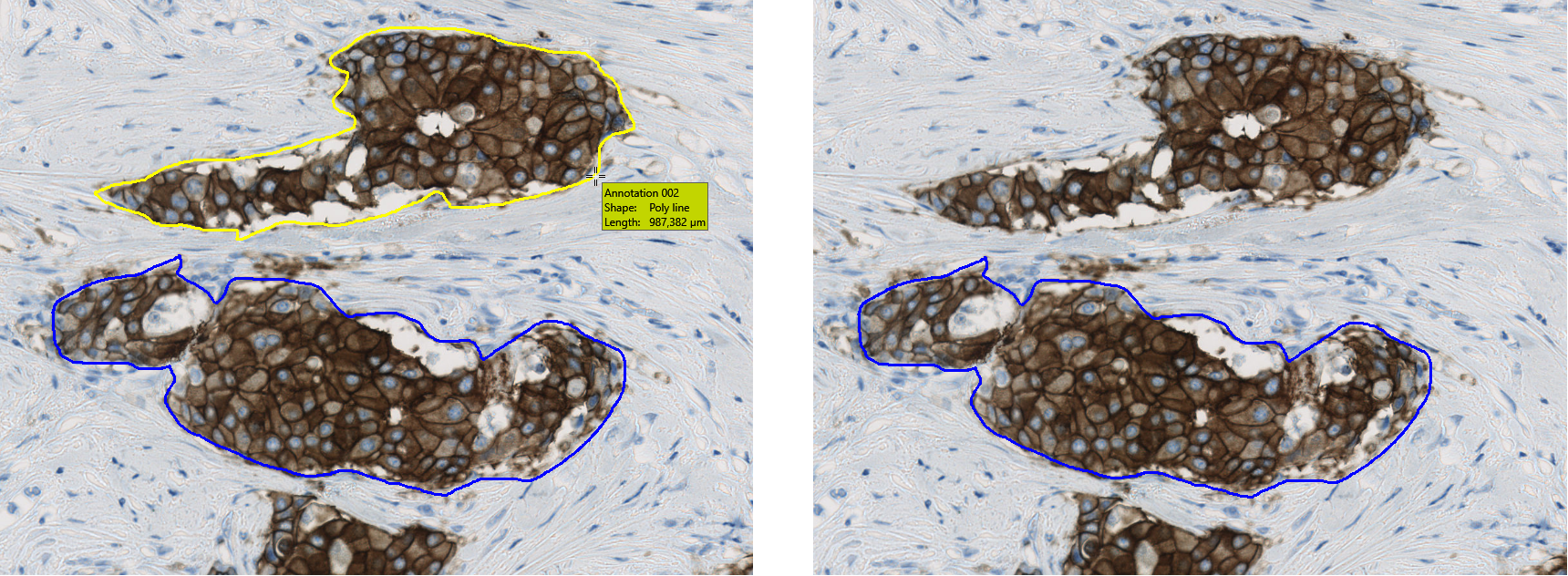 Hover over the annotation to highlight it and press the Delete-key to delete it (Breast cancer tissue, HER2).