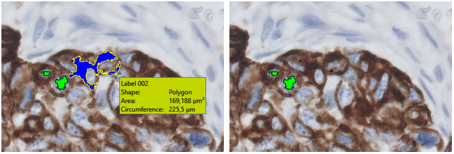 Hover over the label to highlight it and press the Delete-key to delete the label (Bladder tissue DAB stain).