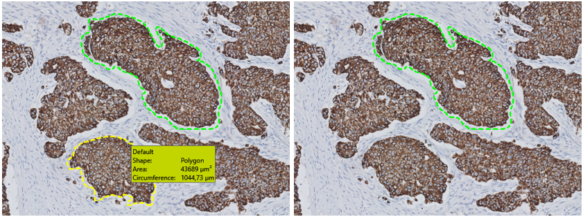 Hover over the ROI to highlight it and press the Delete-key to delete the ROI (Breast cancer tissue CK18).