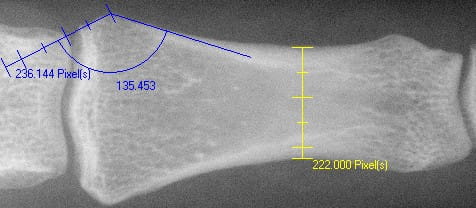 Example of measurement with distance and angle (Finger bone, X-ray)