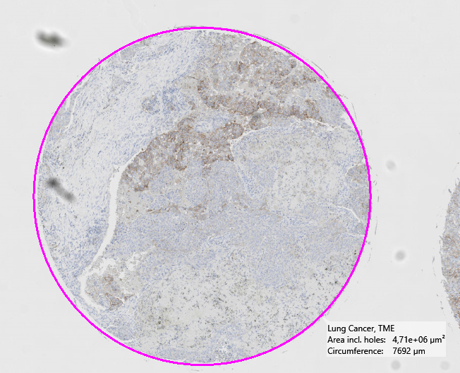 Example of measurement with circumference (Lung Cancer, TME)